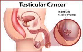 These things are often painless. Testicular Cancer Africa Cancer Hub