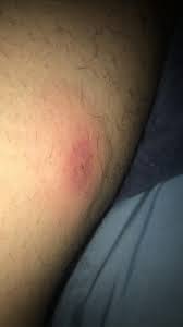 What does a brown recluse spider bite look like? Recluse Bite Brownreclusebites