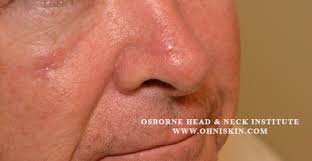 The general definition of a lesion is an area of atypical tissue, according to the national cancer institute. Treatment Of Multiple Skin Cancer Lesions