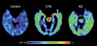 The brain scan came as a surprise even to researchers who for years have been studying the yet a posthumous examination of his brain showed he had such a severe form of the degenerative brain. Brain Imaging Tackling Chronic Traumatic Encephalopathy Nih Director S Blog