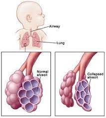 Desease And Health Problem Respiratory Distress Syndrome Hyaline Membrane Disease