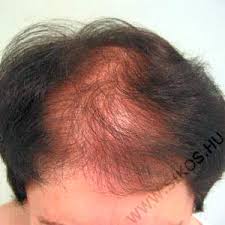 Jun 08, 2021 · gegen schimmelflecken werden allerlei hausmittel empfohlen. Haartransplantation
