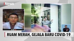 Mengutip laman covid.joinzoe.com, studi yang dipimpin para peneliti dari king's college london, inggris, dan perusahaan ilmu kesehatan zoe didasari oleh. Dr Muhammad Fajri Adda I Ruam Merah Di Kulit Bukan Berarti Gejala Covid 19 Inews Siang 27 12 Youtube
