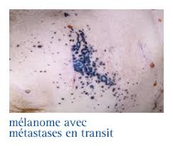 Nous sommes tous inégaux face au mélanome, même si les peaux rousses sont plus susceptibles de développer un mélanome, les peaux méditerranéennes peuvent également en être victimes. Infocancer Arcagy Gineco Localisations Autres Cancers Melanome Maladie Le Melanome