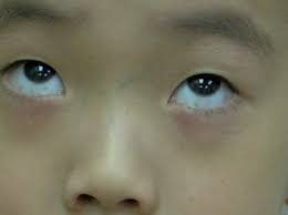 Image result for melanosis sclera