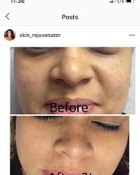 Sally Guy Annas (@skin_rejuvenator) • Instagram photos and videos