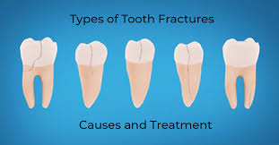 Image result for Tooth Fracture