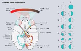 Image result for Visual Field Deficit