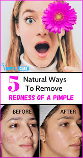 Sometimes these lesions can leave red or dark spots on your skin. Pin On Beauty