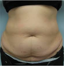 Tummy Tuck Surgery Glendale | Abdominoplasty Beverly Hills- Before & After