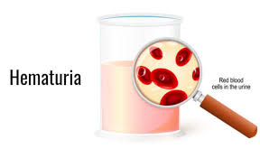 Learn more about what to look for and other symptoms that may be present. 7 Signs Of Kidney Cancer You Should Know About Medanta