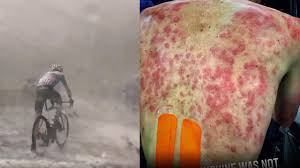 Grandinata record in val seriana. Ciclismo Grandine Come Proiettili Al Giro Del Delfinato Ecco La Schiena Di Tim Declerq A Fine Tappa La Stampa