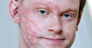 Acid attack driver needed surgery after having chemicals thrown in his face  by 'complete stranger'