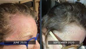 Before After Photos