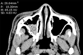Image result for Sinus CT