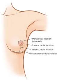 Image result for Mastectomy
