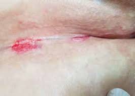 Jul 06, 2021 · a superficial dermatitis occurring on skin surfaces in contact with each other, such as the axillae, neck creases, intergluteal fold, between the toes, etc. Summer Time Is Intertrigo Time Ligamed Medical Products Gmbh