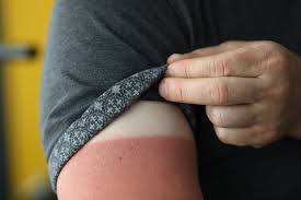 Image result for Sunburn
