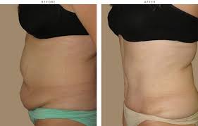 A Tummy Tuck Is Suitable For Men And Women Who Are In Good Health Tummy Tuck Abdominoplasty Before After Pictures Tummy Tucks Abdominoplasty Tummy
