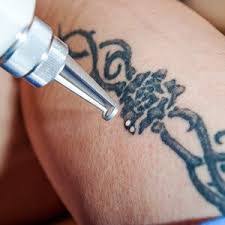 Since no two tattoo removal treatments are the same, we recommend that all people interested in our services schedule their free consultation to learn… Home Anticipation Tattoo Removal