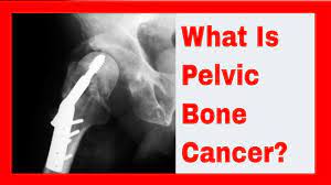 Chondrosarcoma is the rarest bone cancer, primarily affecting adults older than 40 years. Pain Above Hip Bone