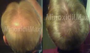 Finasteride, sold under brand names like procecia and proscar works as a hair loss inhibitor. Topical Finasteride Professionally Formulated Save
