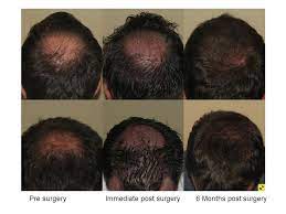 Täglich bestens informiert aus erster hand! Haartransplantation Forum Arzte Und Kliniken Vor Dem Eingriff Shapiro Crown Work 6 Monate Post Op