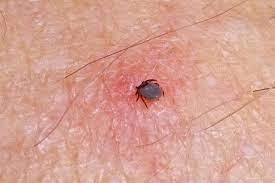 How To Tell If Tick Head Is Still In Skin And How To Get It Out