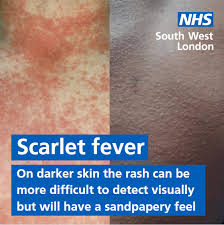 Image result for Scarlet Fever