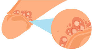 Image result for genital herpes