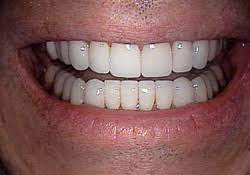 Veneers can last many years when planned and done well. How Long Do Porcelain Veneers Last Dr Marsh Dds