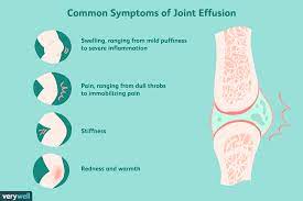 The design team may decide to close this. Joint Effusion Symptoms Causes Diagnosis Treatment