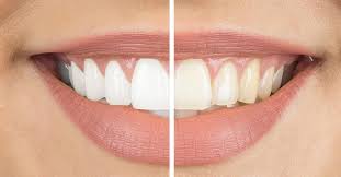 Also known as sodium bicarbonate, baking soda is a very fine, crystalline white powder that is composed of sodium and bicarbonate ions.5 this substance is an alkaline — when you blend it with an acid, it can change its ph level.6. How To Naturally Whiten Your Teeth At Home