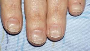 What Do Ridges Or Horizontal Lines In Your Fingernails Mean In 2020 Nail Health Nail Health Signs Lines On Nails