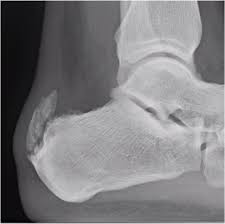 Calcific Achilles Tendonitis In Athletes Podiatry Today