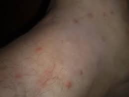 In genere si manifestano sulle aree scoperte del applica il gel di aloe vera sulla zona colpita dalle punture. Sono Cimici O No Freeforumzone