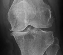 The main symptoms of osteoarthritis are joint pain and stiffness, and problems moving the joint. Mit Stammzellen Gegen Arthrose Universitat Wurzburg