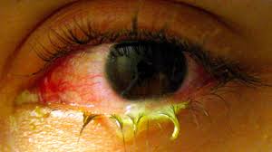 Image result for Conjunctivitis Resources