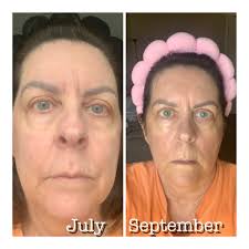 RIMAN TESTIMONY👇 What an amazing testimony by Audra! ￼Wow!! Look at these  incredible results🤩 “I'm almost embarrassed to show this before picture  from 7 years ago at age 50. Chronic dark circles!!