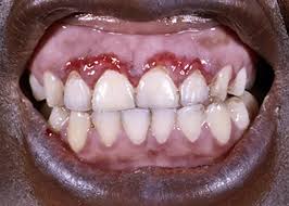 Image result for gums cancer symptoms