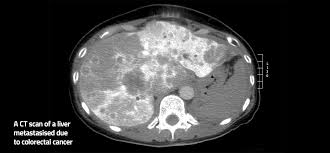 If a screening test result is abnormal, you may need to have more tests done to find out if you have cancer. Colo Met Eit Health