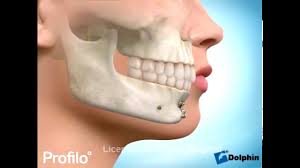 Mon stomato m'a indiqué de mettre une goutière pour pouvoir réaxer la machoire car a force d'attendre et de rester avec les douleurs elle s'est désaxée. La Chirurgie Orthognatique Specialiste Qualifie En Orthodontie Tarare