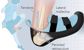 Mri show obliq tear body and posterior horn lateral meniscus, extending infr artic surface and ulceration articular cartilage patella. Snapped Ankle Tendon Rock And Ice Magazine