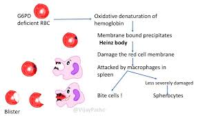 Image result for G6PD Deficiency Detection