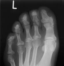 Image result for XRay Changes in Rheumatic Conditions