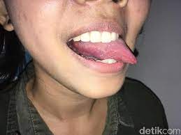 Cara penanganan sariawan yang satu ini sangat tepat sekali. 9 Obat Sariawan Alami Ini Bikin Kamu Bisa Makan Enak Lagi