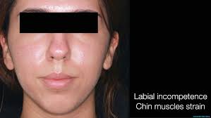 ⭐ MARPE-BAME: Expansión palatina rápida.