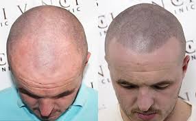 Any area of the scalp with hair loss can be shaded, from the crown to the hairline. Bald Scalp Hair Loss Problem Solved By Hair Tattoo