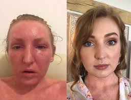 Woman's hell as 'addiction' to eczema steroid cream leaves her bedridden  and jobless