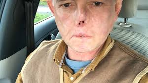 Quién es Jaco Nel? El doctor que perdió sus piernas y el rostro por las  lamidas de su perro